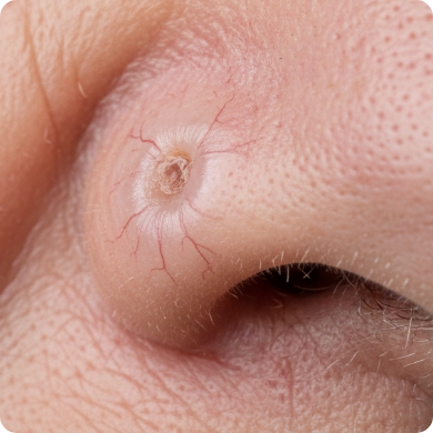 Basalioma (BCC): come riconoscerlo e quando trattarlo