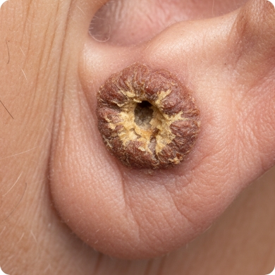 Spinalioma (SCC): sintomi, segnalid’allarme e come riconoscerlo