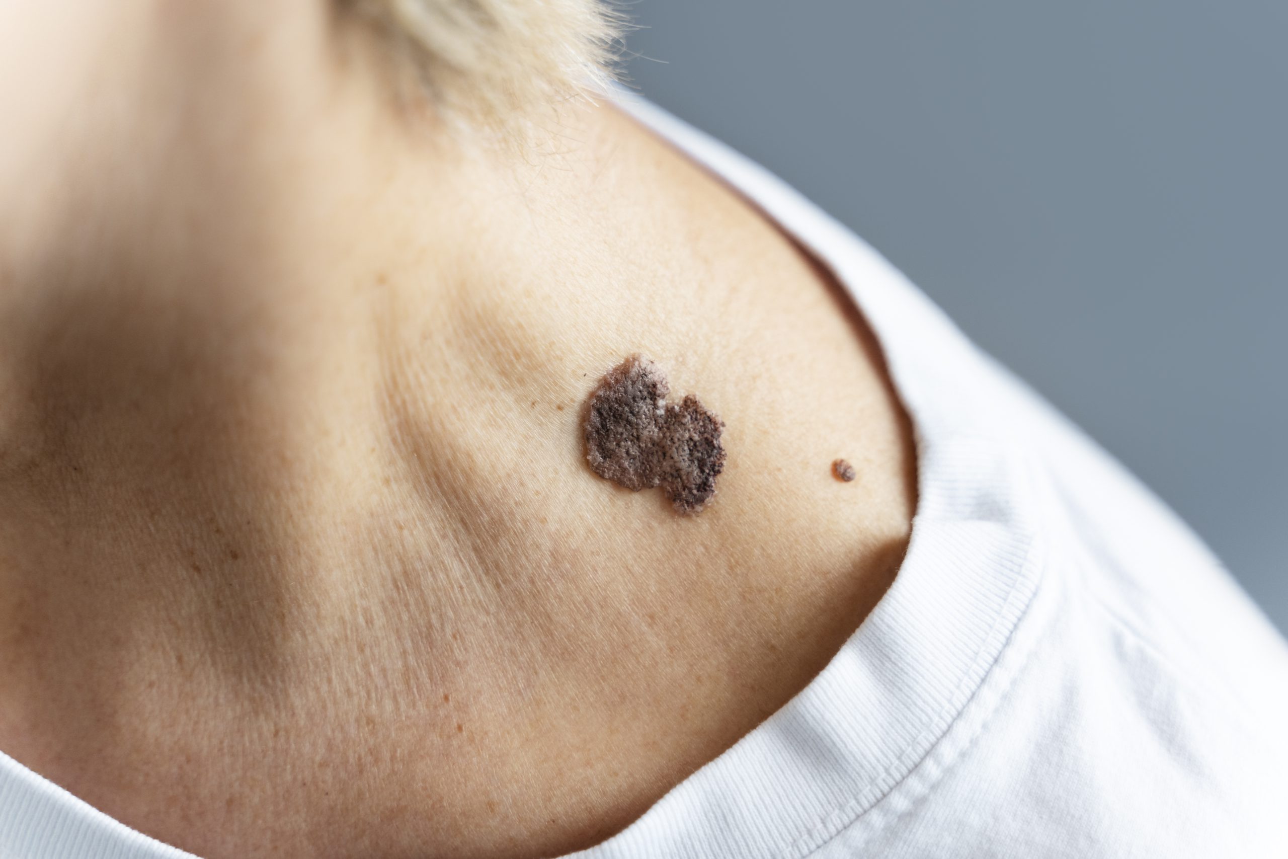 Melanoma: come riconoscerlo con la regola ABCDE