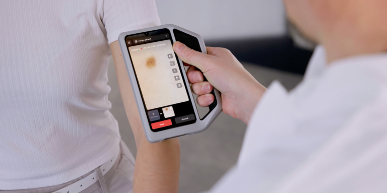 Dermatoscopia digitale: perché è fondamentale nella diagnosi precoce dei tumori cutanei